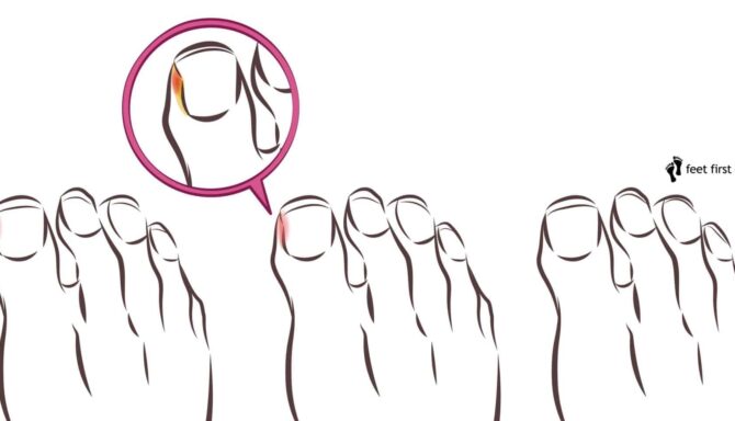 How To Prevent And Treat Ingrown Toenails Feet First Clinic