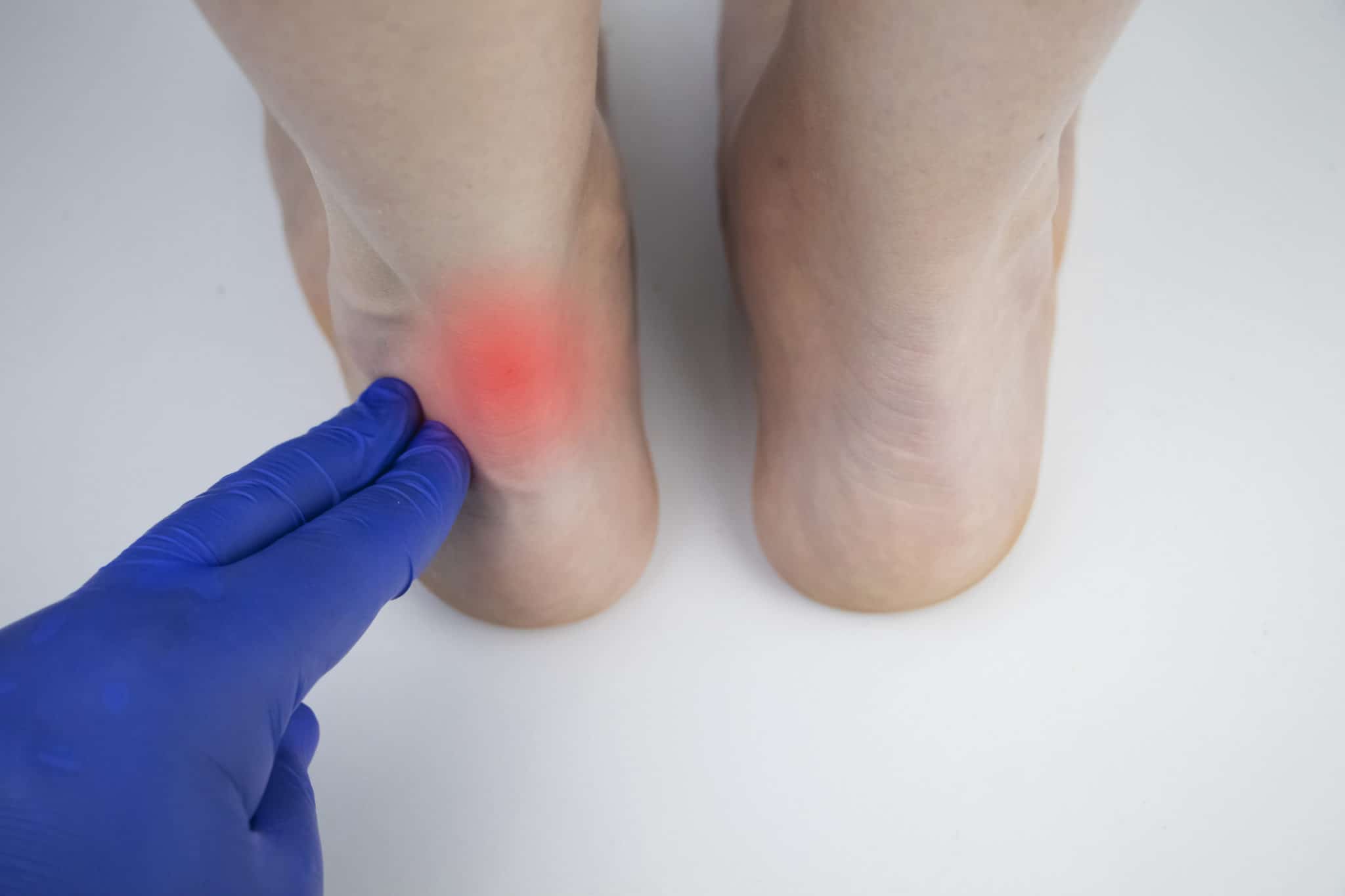 Achilles Tendonosis Foot Specialist Toronto Feet First Clinic