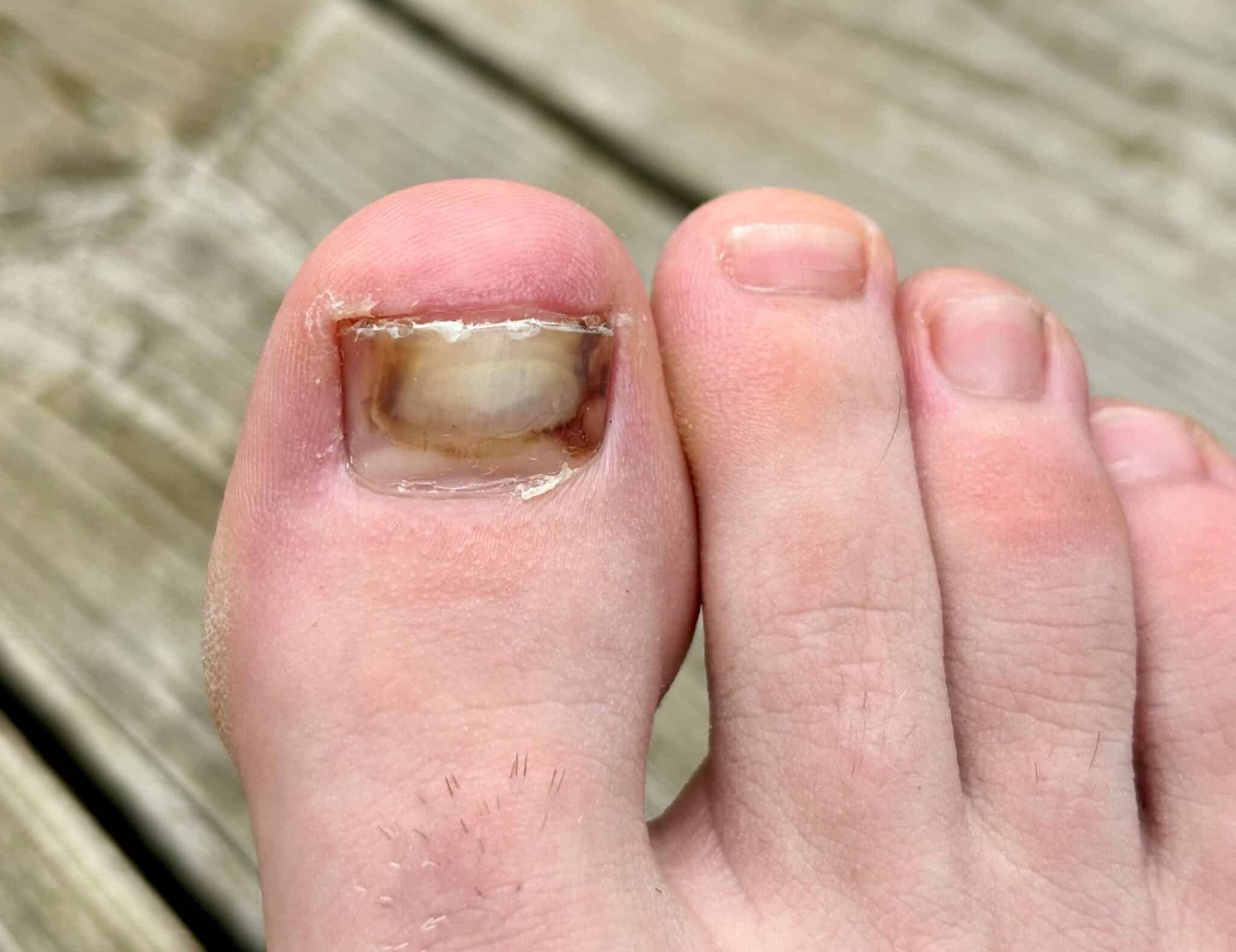 Tips For When Your Toenail Is On The Verge Of Falling Off Feet First