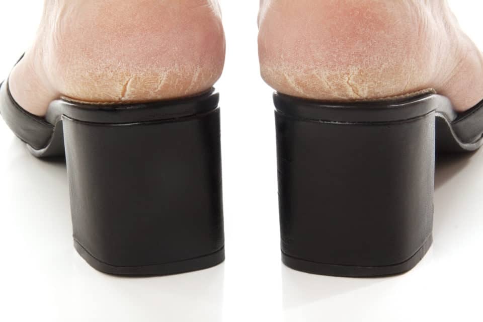 Cracked Heels And Heel Fissures The Dangers And What You Can Do Feet