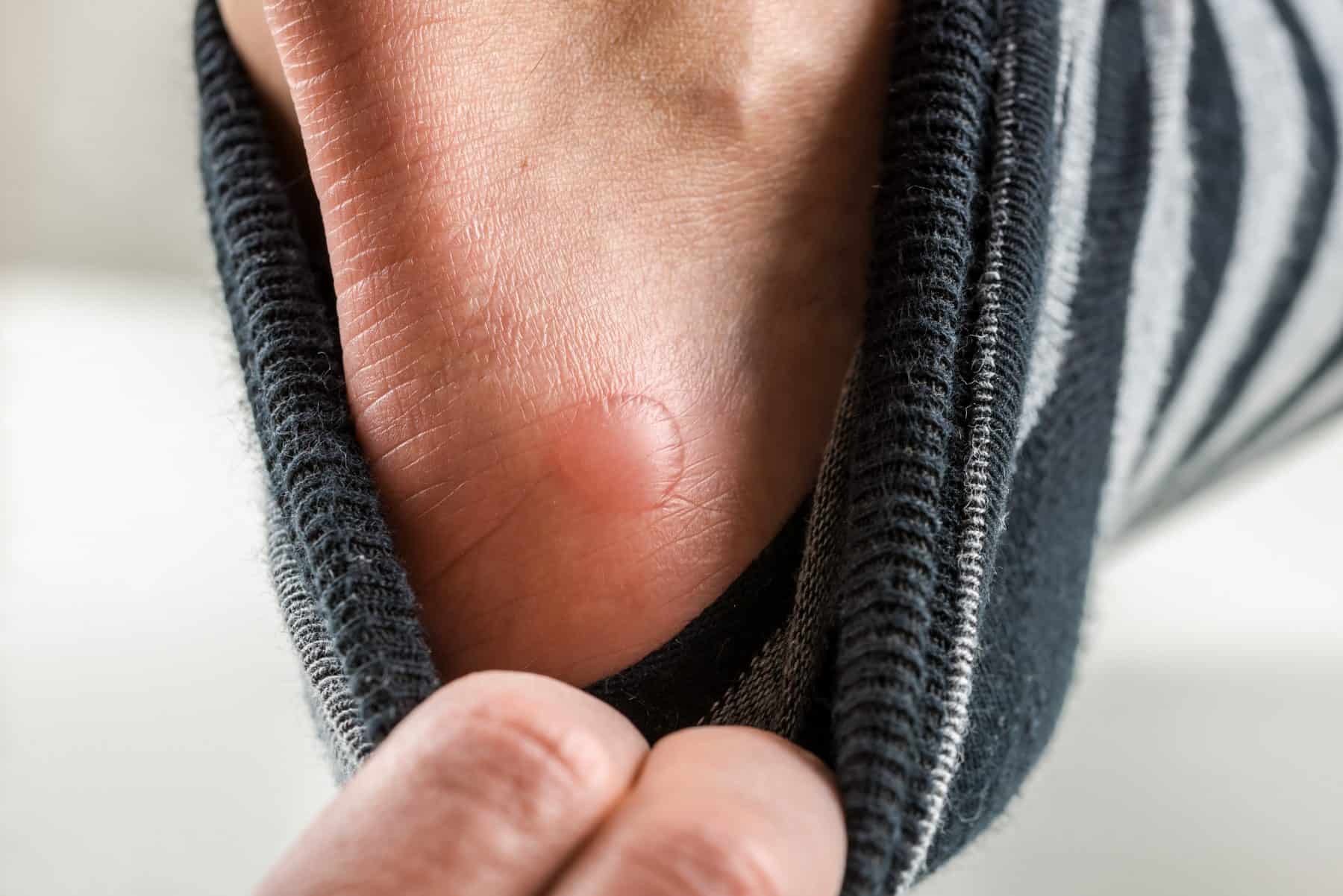 blisters-feet-first-clinic