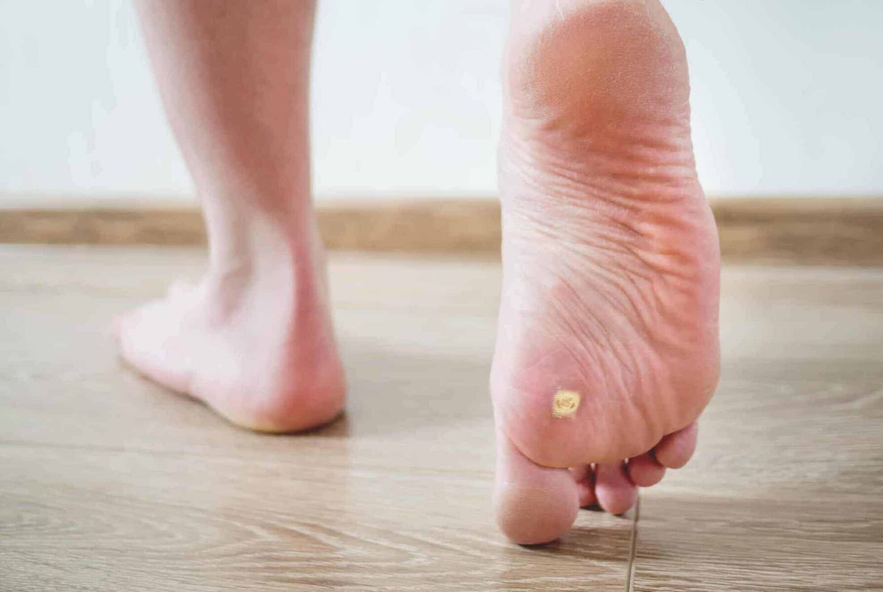 Managing Plantar Warts in Children A Guide for Parents Feet First Clinic