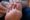 Image of plantar wart
