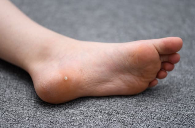 wart-on-the-plantar-wart-on-the-foot-stock-photo-by-dmitryi-332609890