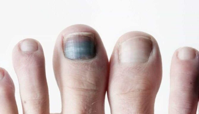 Discoloured Toenails Foot Specialist Toronto Feet First Clinic 