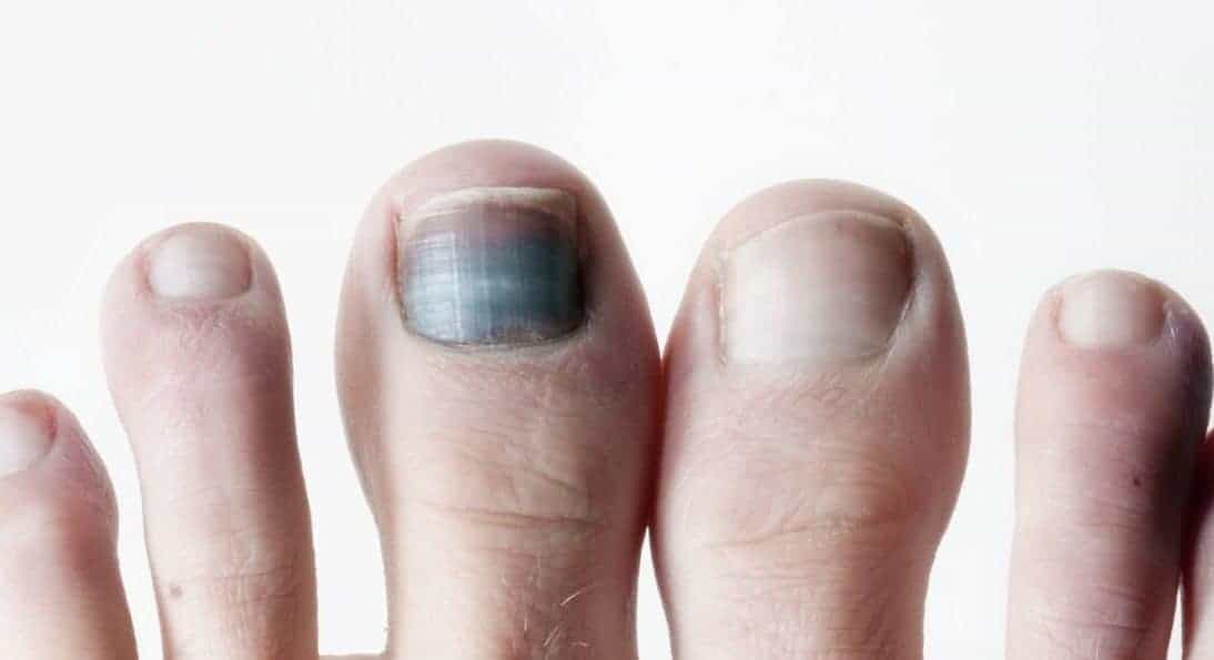 Discoloured Toenail Black Toenail 