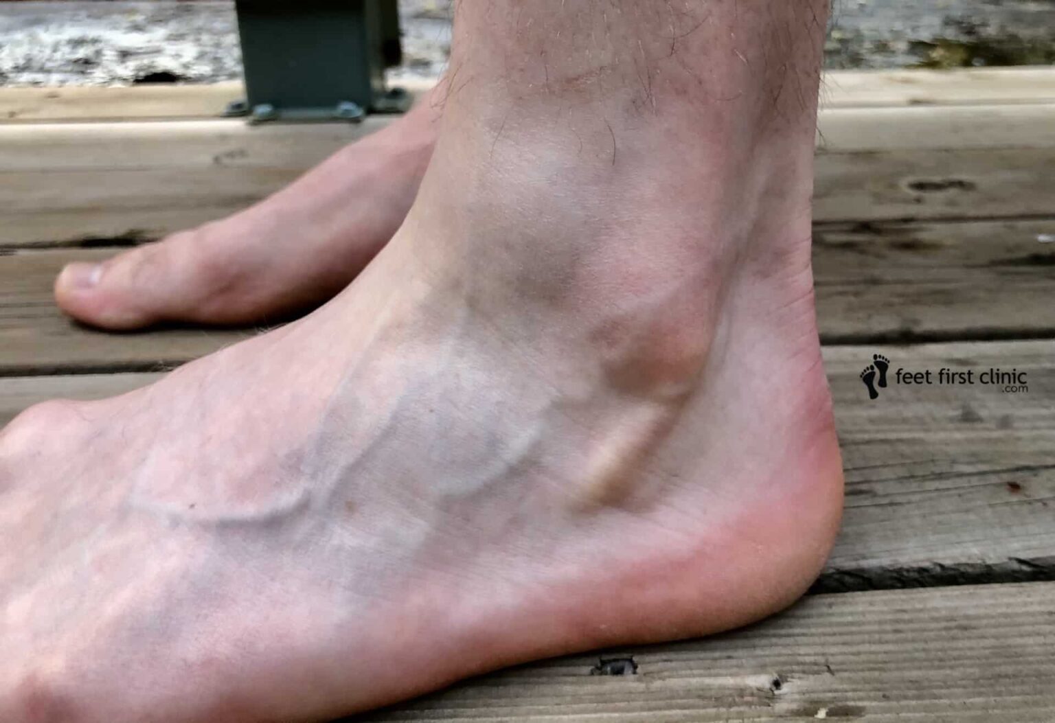 Ganglion Cyst On Top Of The Foot What Is It Feet First Clinic