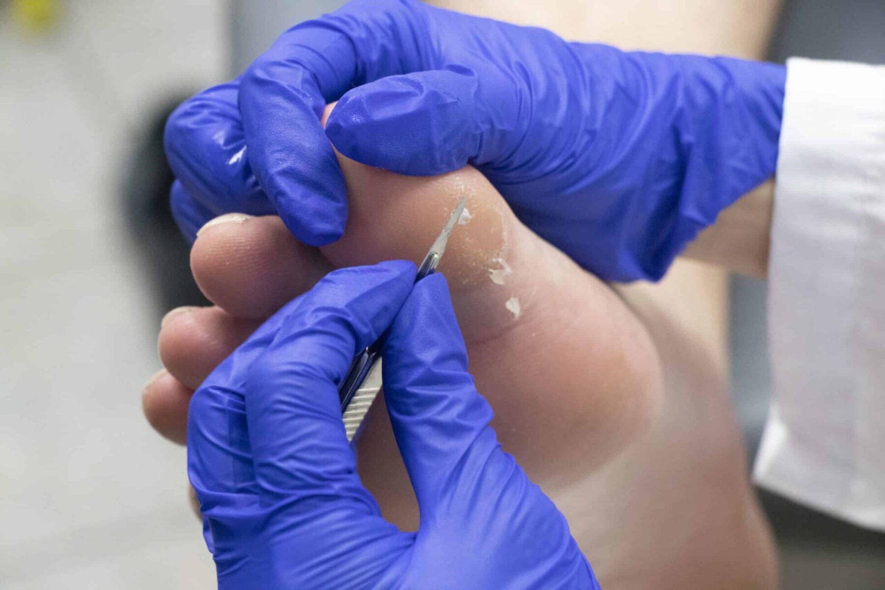 All About Corns Feet First Clinic