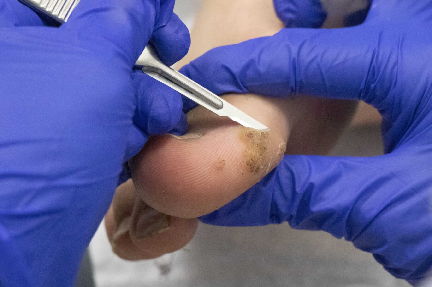 Wart Removal Foot Specialist Toronto Feet First Clinic