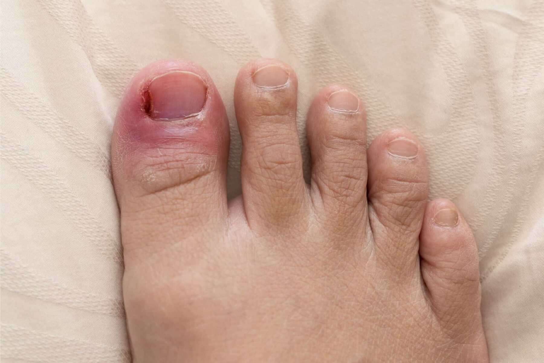 Why Do I Have Red Toes An Overview Causes And Prevention Feet   IStock 1188649789 1 Scaled 