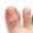 Ingrown toenail with inflammation and damage to surrounding skin