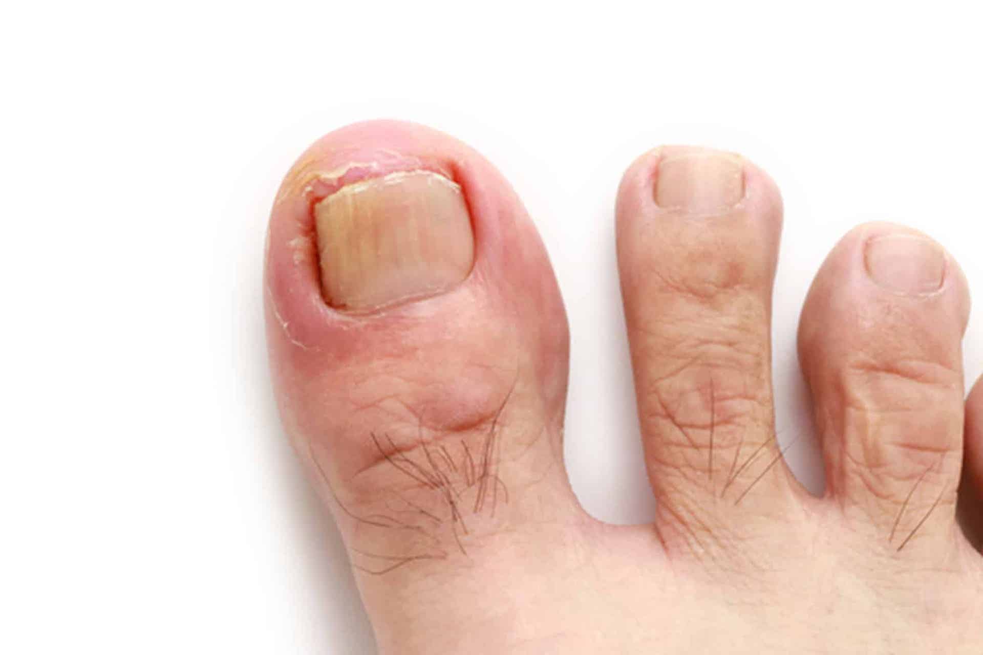 How To Prevent And Treat Ingrown Toenails Feet First Clinic