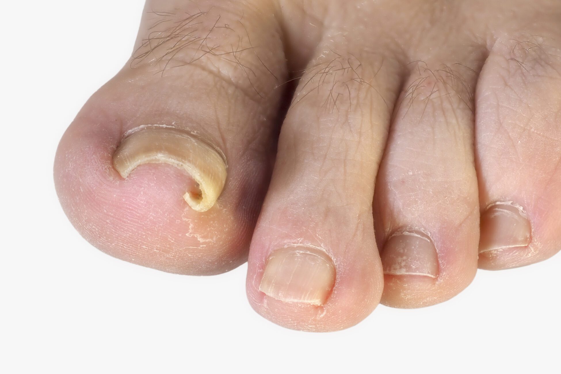 Toenail Thickening Causes and How to Manage Feet First Clinic