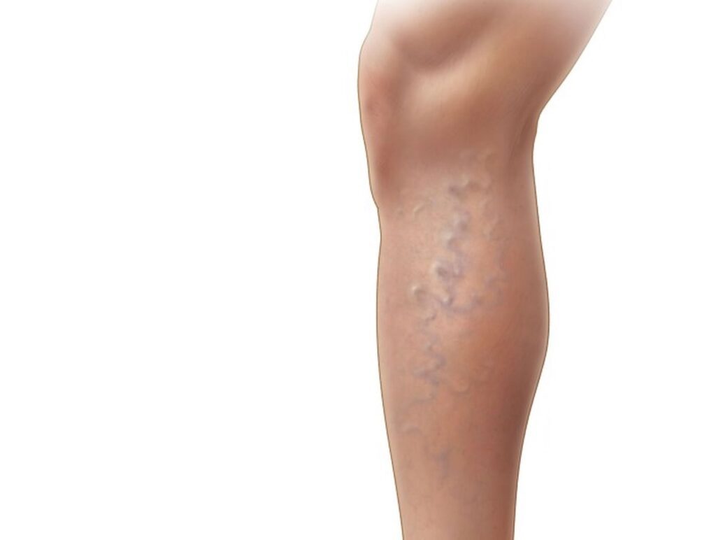 The Best Compression Stockings for Varicose Veins How to Choose the