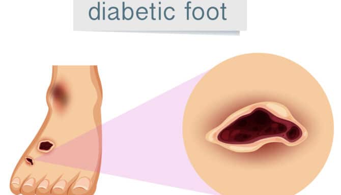 Illustration showing diabetic foot also known as a diabetic ulcer