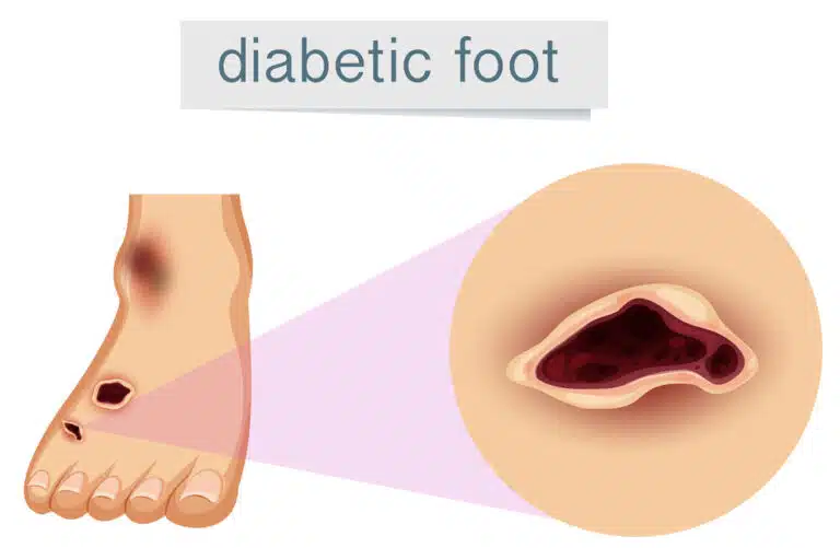 Illustration showing diabetic foot also known as a diabetic ulcer