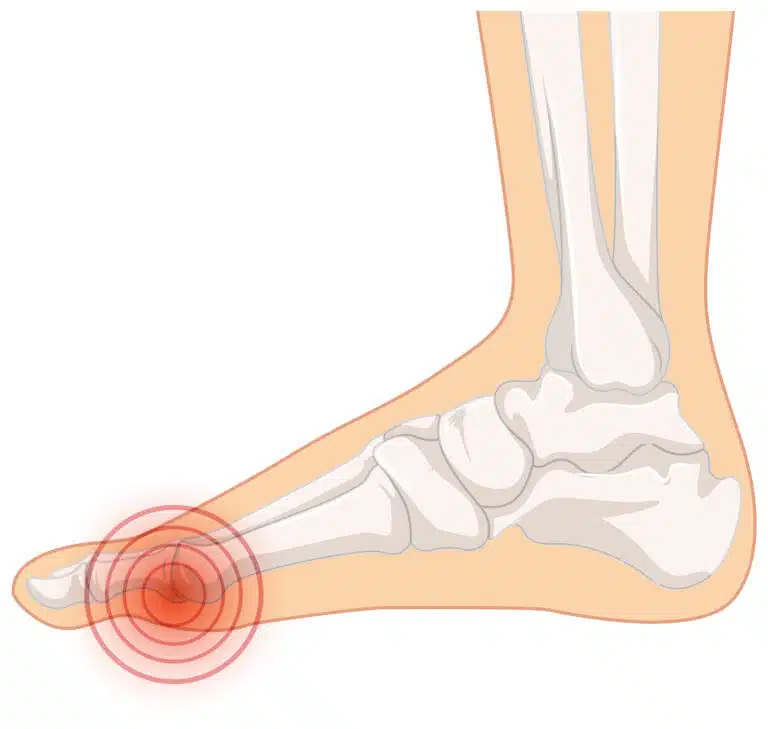 Illustration of joint affected by bunions