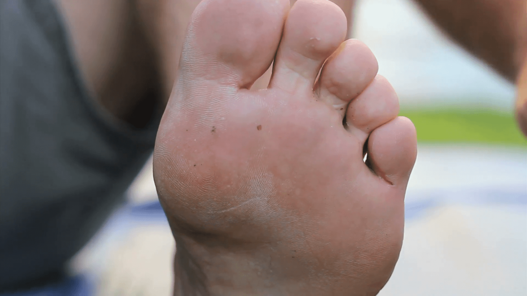 Athlete's Foot | Foot Specialist Toronto | Feet First Clinic