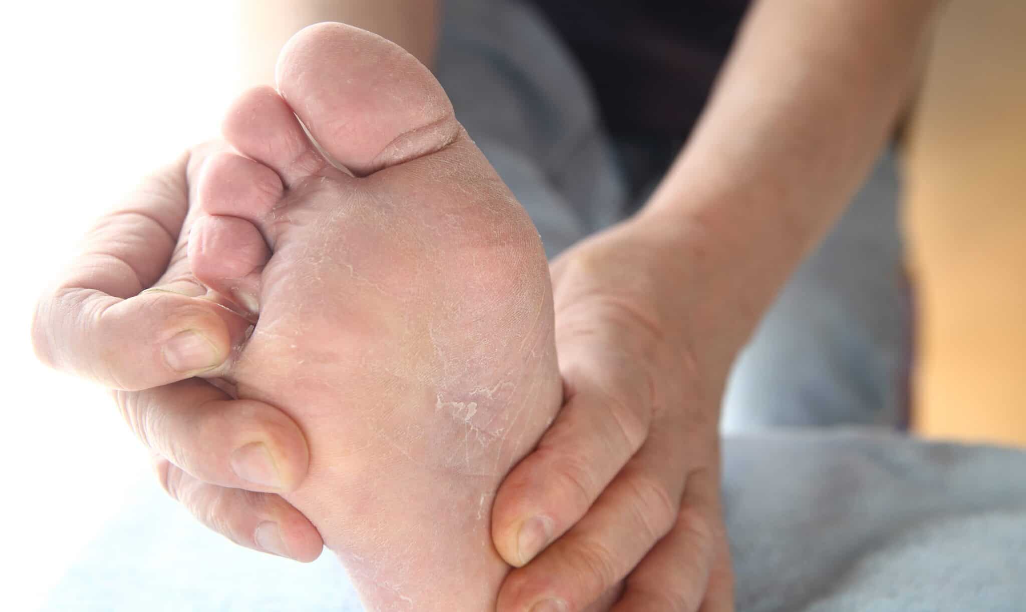 Athlete's Foot | Foot Specialist Toronto | Feet First Clinic