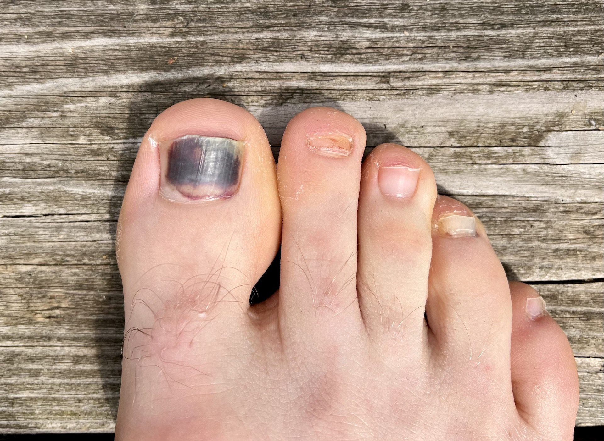 Yellow Toenails — Causes and Treatment - Canyon Oaks Foot & Ankle