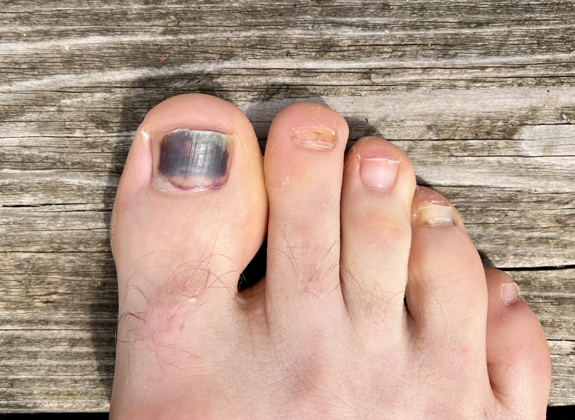 Black Toenail: Causes, Treatment, and Prevention Tips - Feet First Clinic