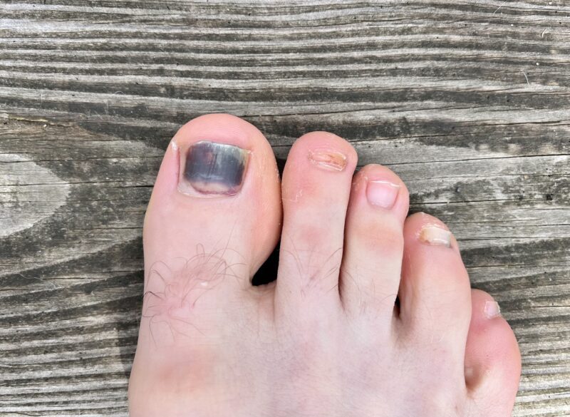 Black Toenail: Causes, Treatment, and Prevention Tips - Feet First Clinic