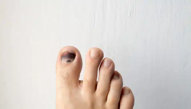 View of toes in front of a white background with a pronounced black toenail on the big toe