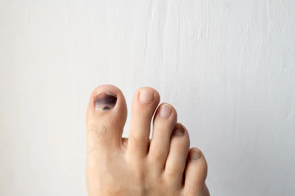 View of toes in front of a white background with a pronounced black toenail on the big toe