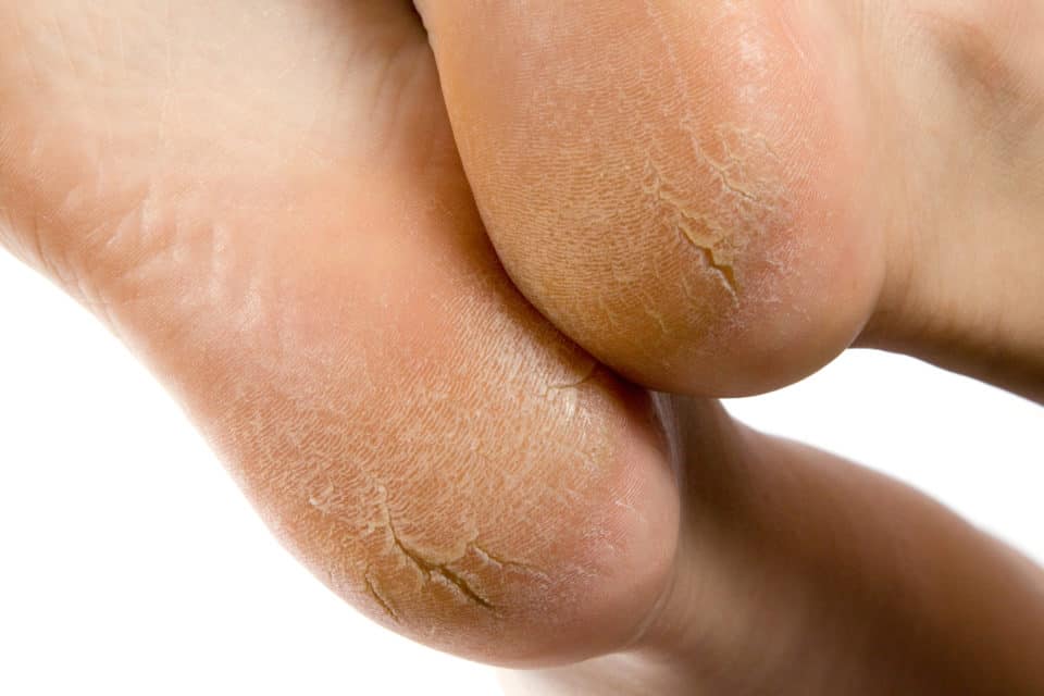 Cracked Heels and Heel Fissures: The 