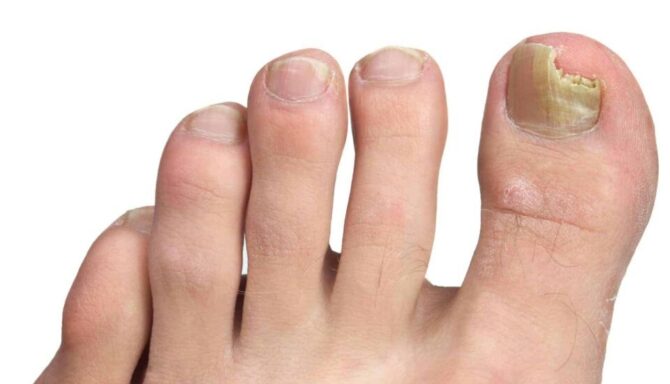 Close up of toenails featuring cracked toenail on big toe and a white background