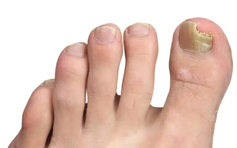 Close up of toenails featuring cracked toenail on big toe and a white background