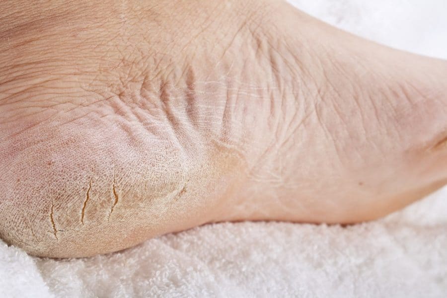 Cracked Heels Foot Specialist Toronto Feet First Clinic