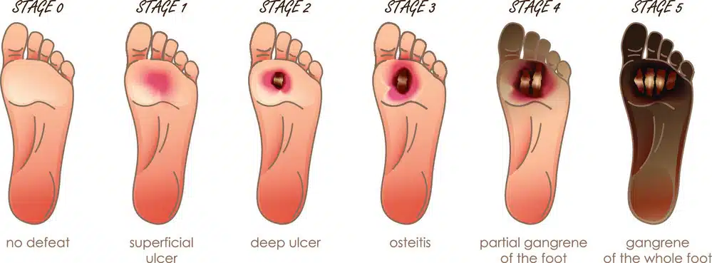 Illustration of a progressively worse diabetic ulcer