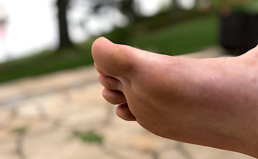 sharp pain under callus foot