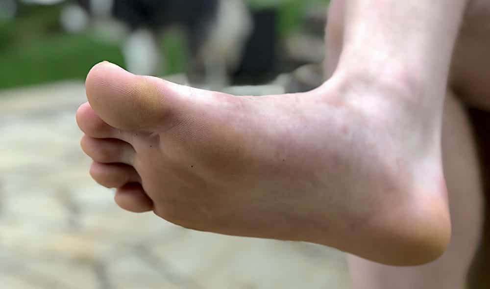 Callus 101: Causes, Prevention and Treatment – Balance Foot & Ankle