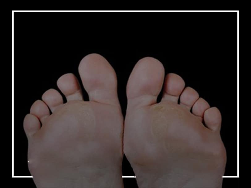 Callus 101: Causes, Prevention and Treatment – Balance Foot & Ankle