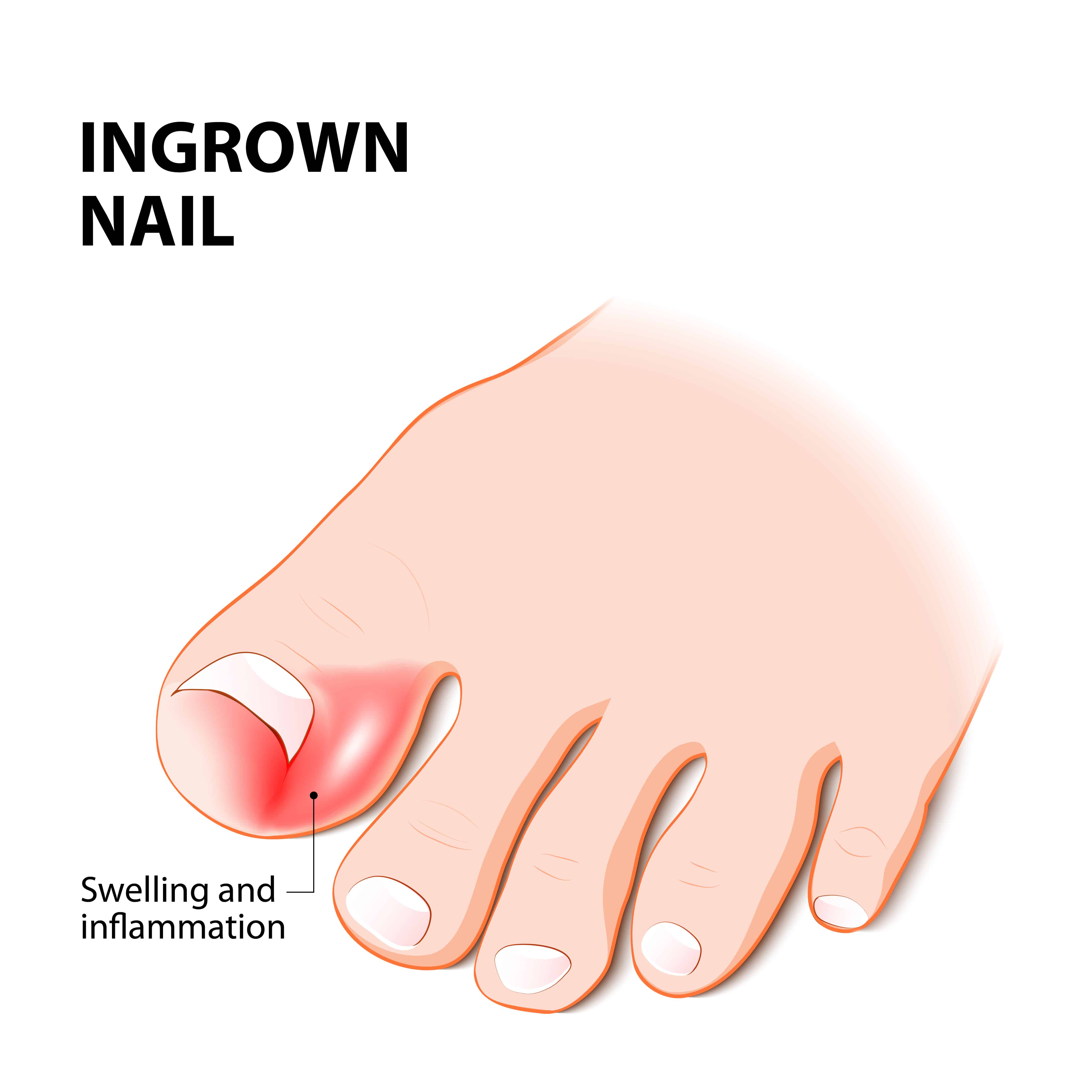 Everything You Need To Know About Ingrown Toenails Feet First Clinic