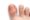 Ingrown toenail with inflammation and damage to surrounding skin