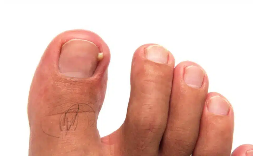 ingrown toenail with swelling and inflammation