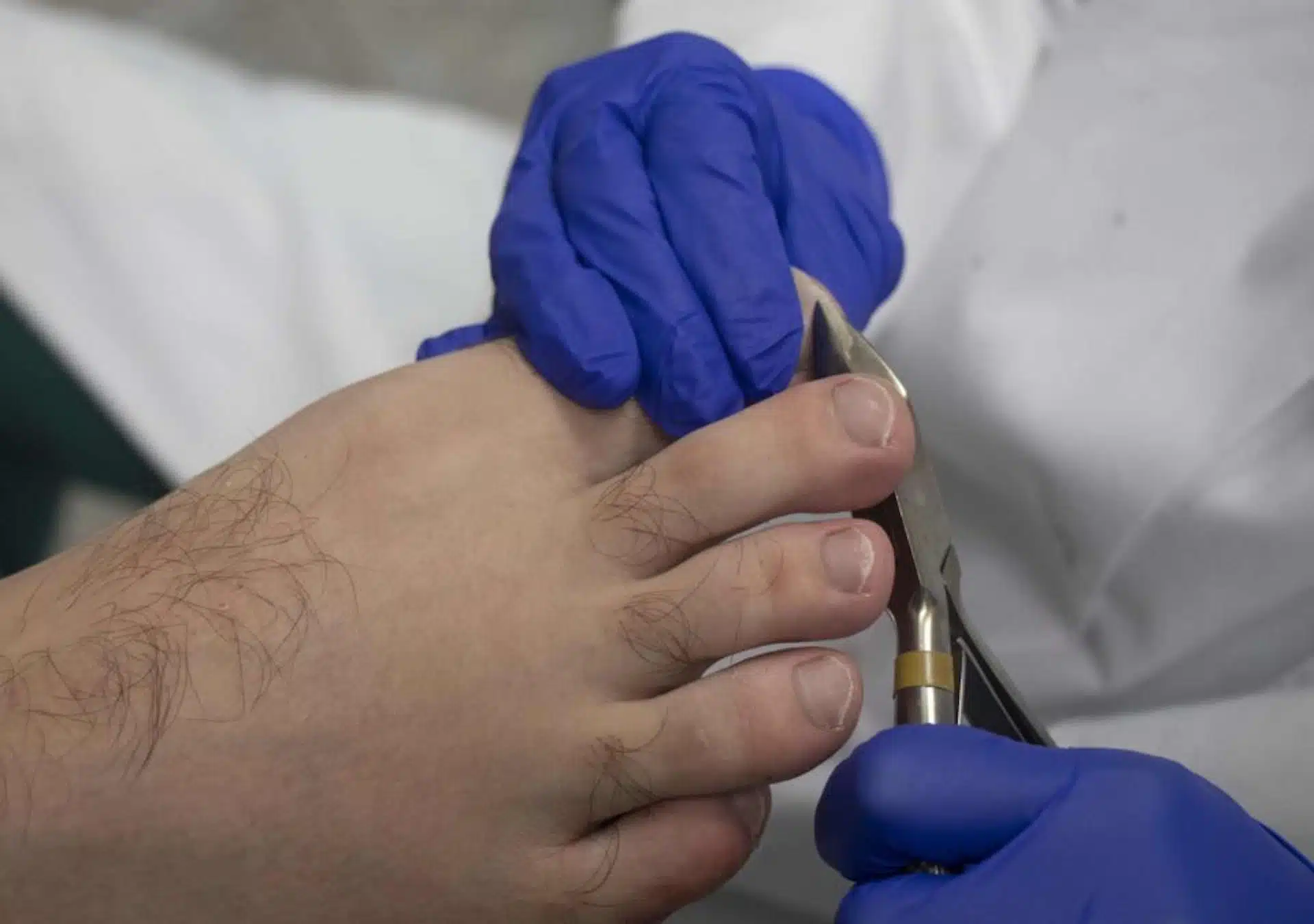 professional nail trimming ingrown toenail prevention