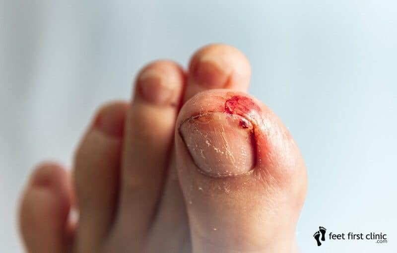 Help! My Toenail is Falling Off! | Feet First Clinic