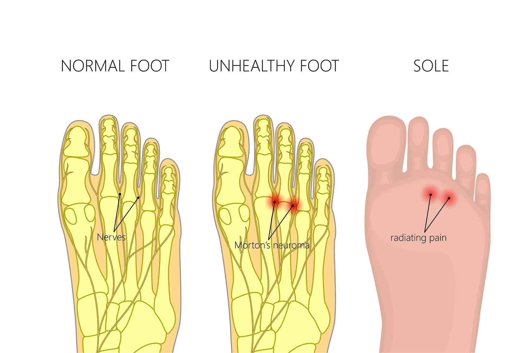 Morton's Neuroma | Foot Specialist Toronto | Feet First Clinic