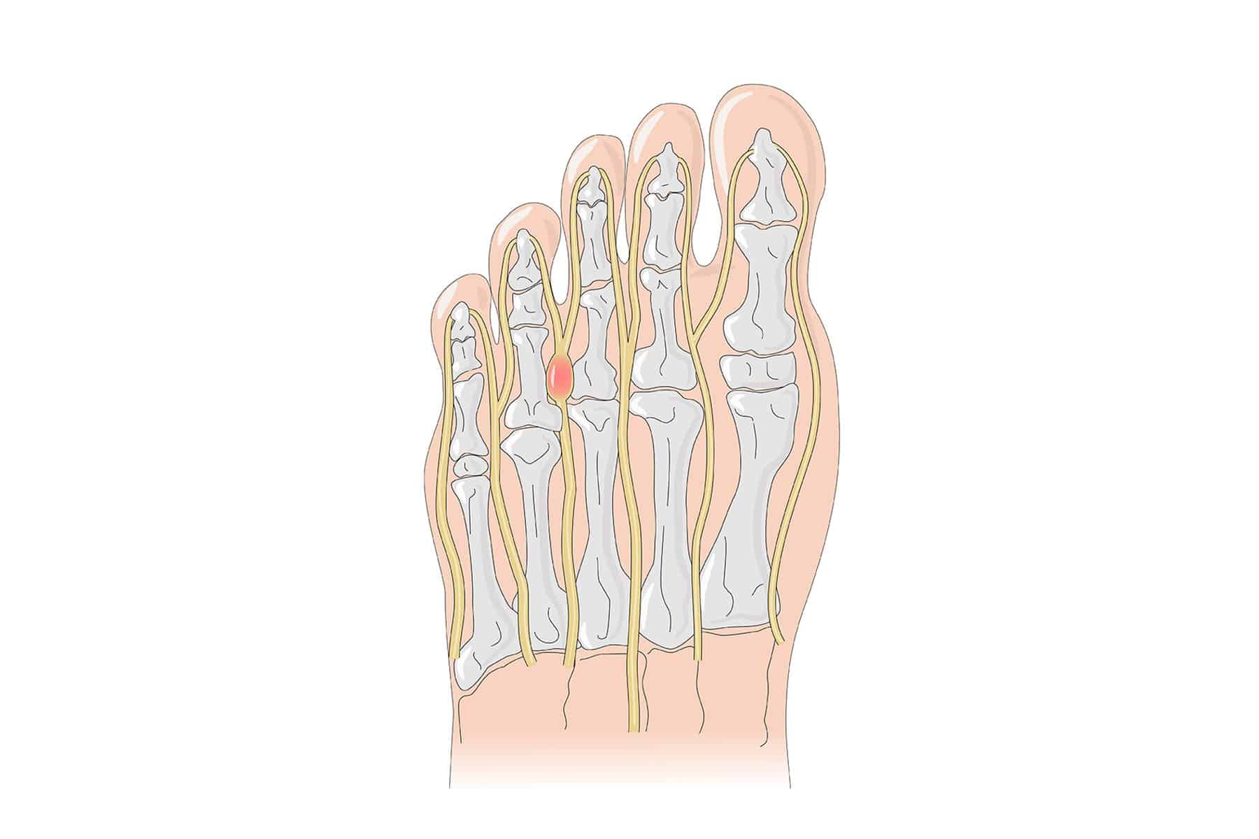 Morton�s Neuroma Foot Specialist Toronto Feet First Clinic