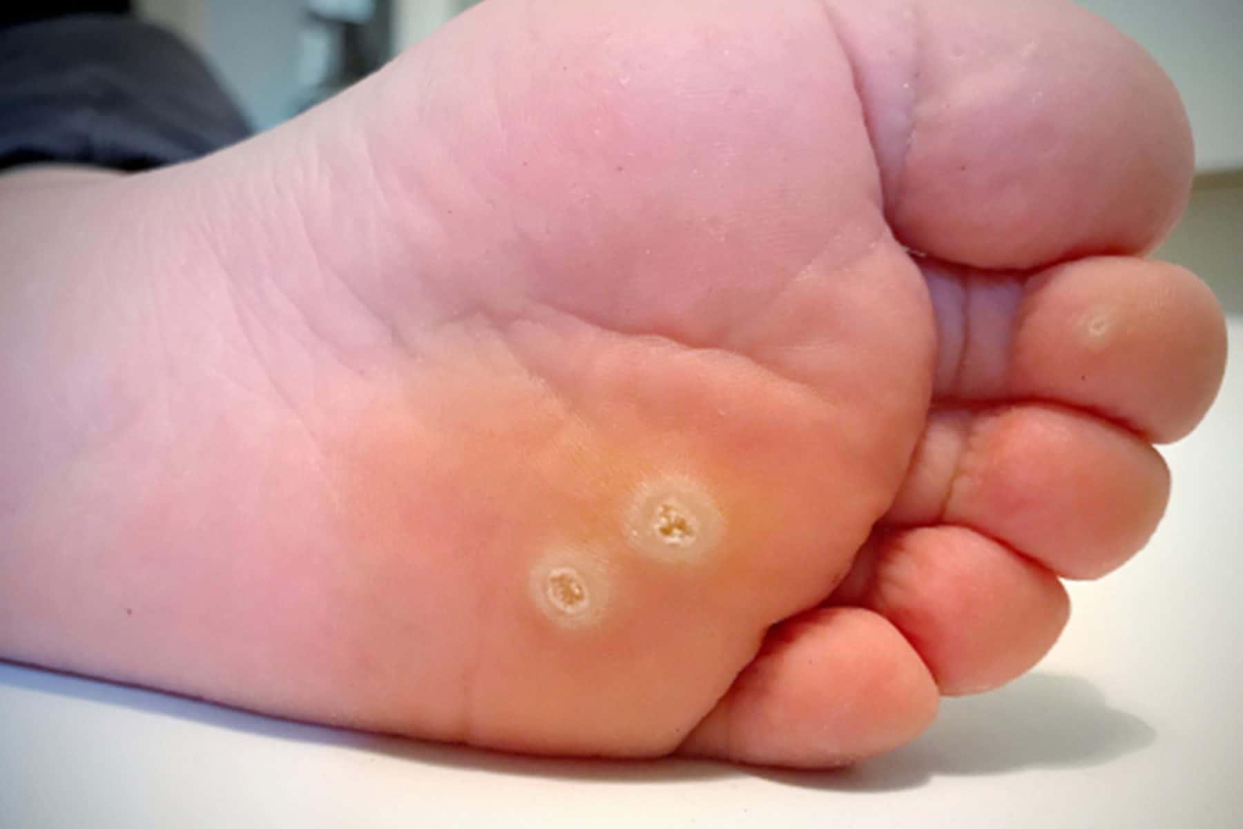 warts in foot)