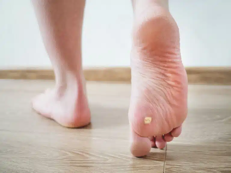 person walking on wooden floor one foot revealing a plantar wart at the bottom