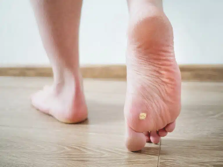 Person walking and raising one foot that shoes several plantar warts on the bottom of the foor