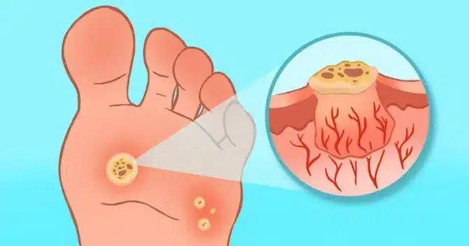 Image showing how plantar warts grow