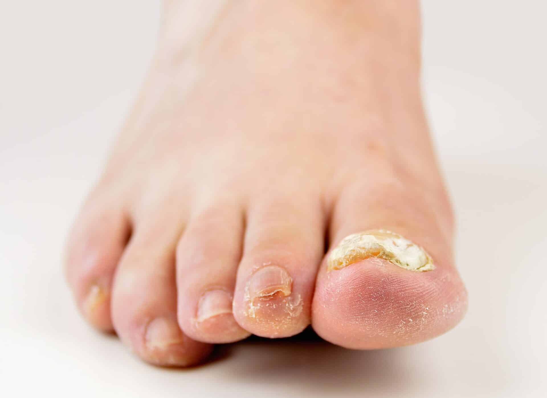 Close up of severely thick toenail big toe