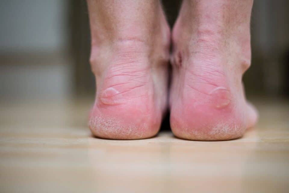 6-summer-foot-problems-and-how-to-treat-them-feet-first-clinic