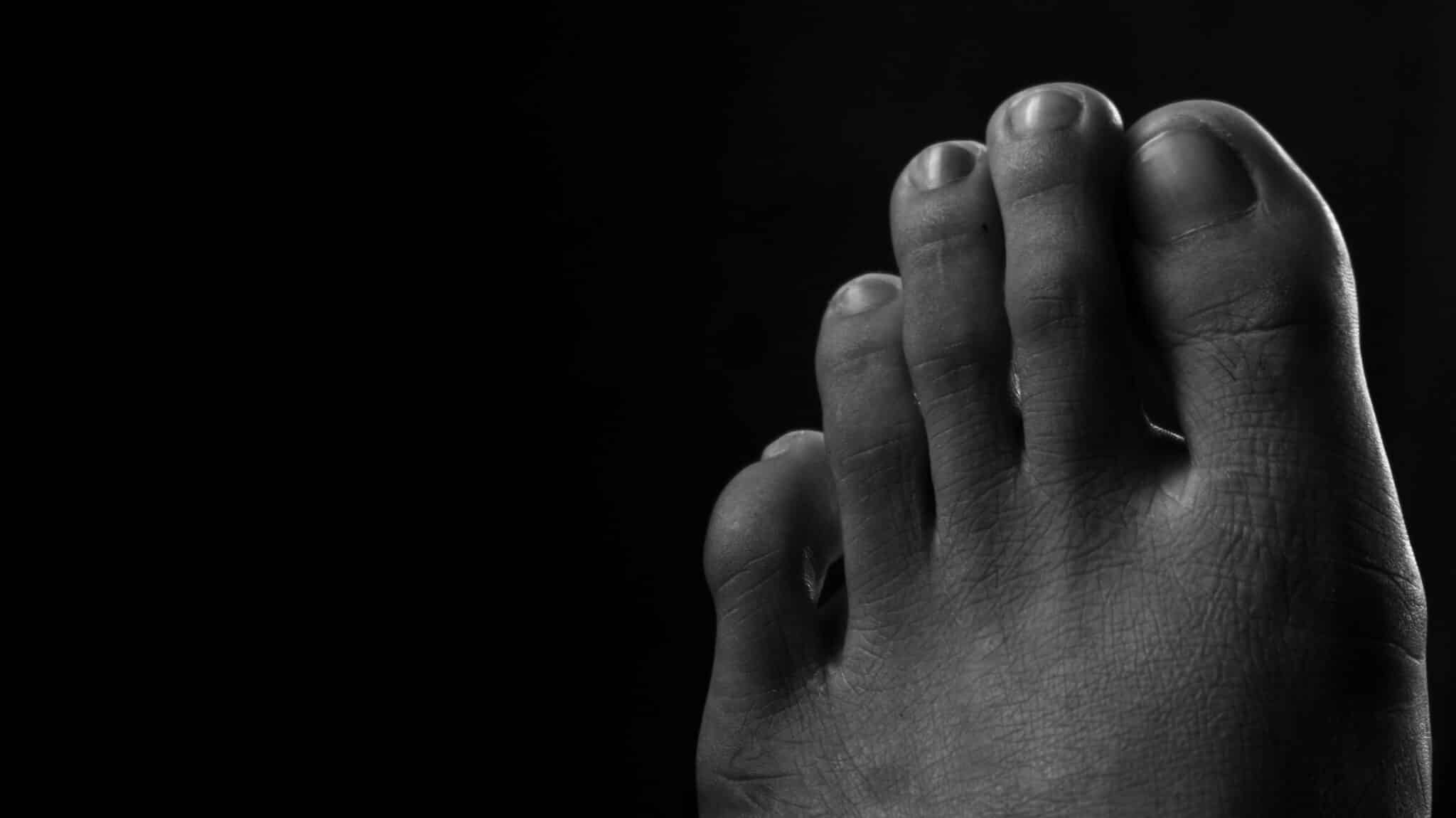 Morton's Toe When Your Second Toe Is Longer Than Your Big Toe Feet